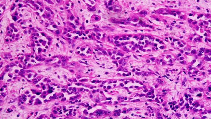 adenocarcinoma