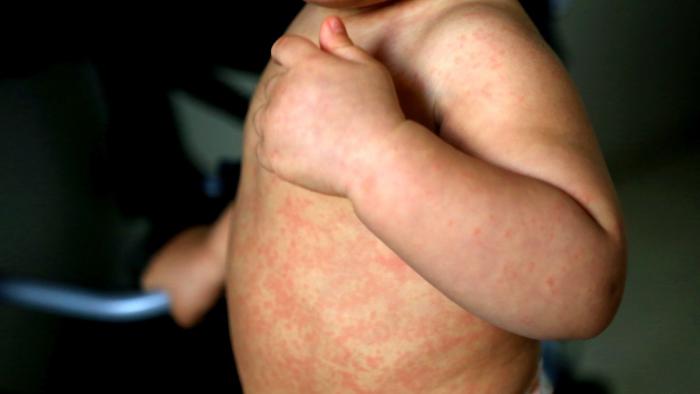 Los casos de sarampión están aumentando en el mundo y ya son superiores a los registrados antes de la pandemia sarampión