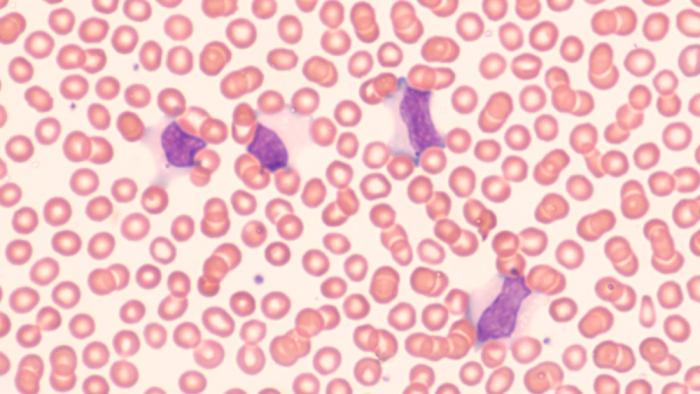 Identifican componentes del virus de Epstein-Barr relacionados con el desarrollo de esclerosis múltiple EBV
